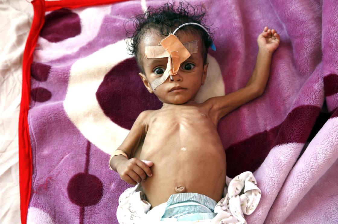 A baby receives treatment for malnutrition, Yemen, March 14, 2022. (AA Photo)